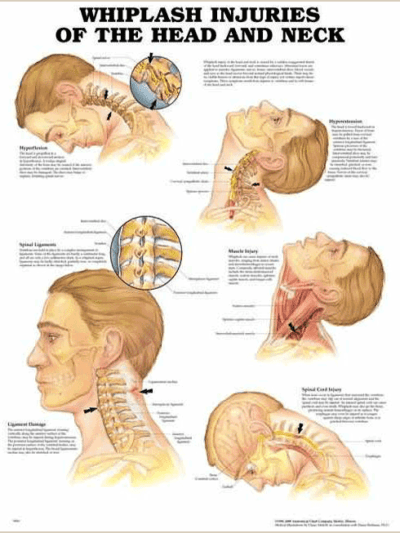 Whiplash Injuries Chart