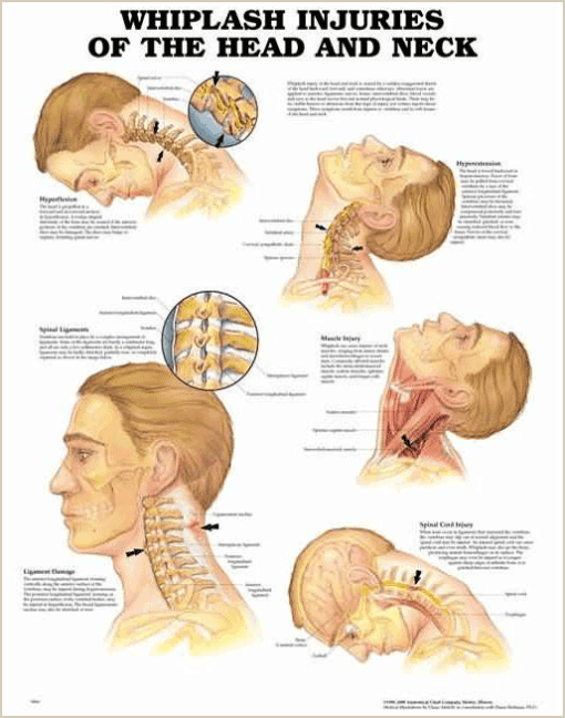 Whiplash Injuries Chart